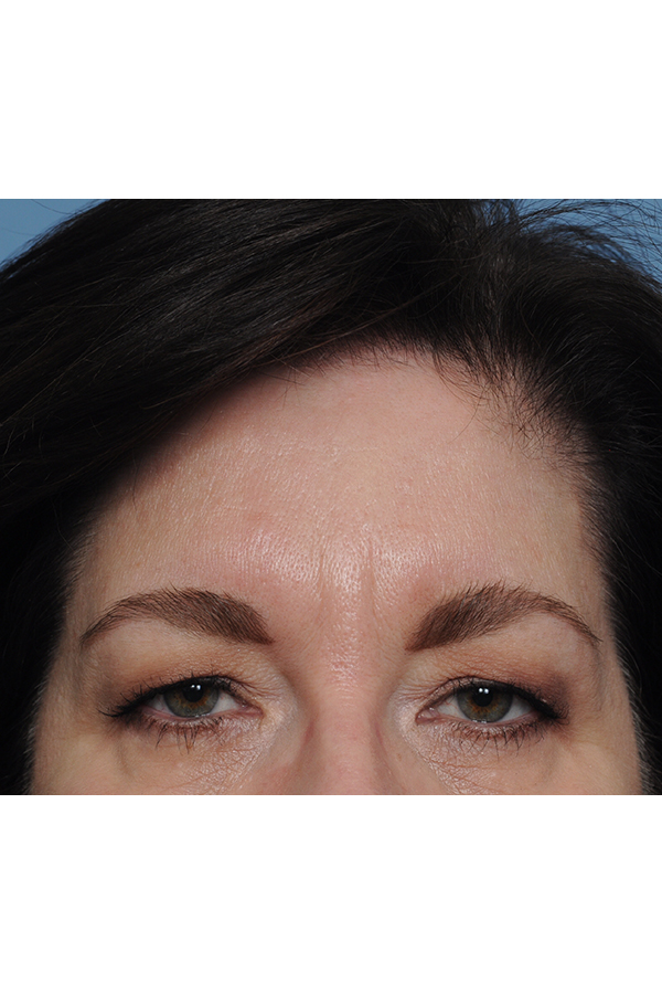 Brow Lift Before & After Gallery - Patient 8376514 - Image 3