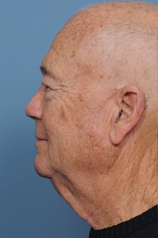 Brow Lift Before & After Gallery - Patient 8376515 - Image 3