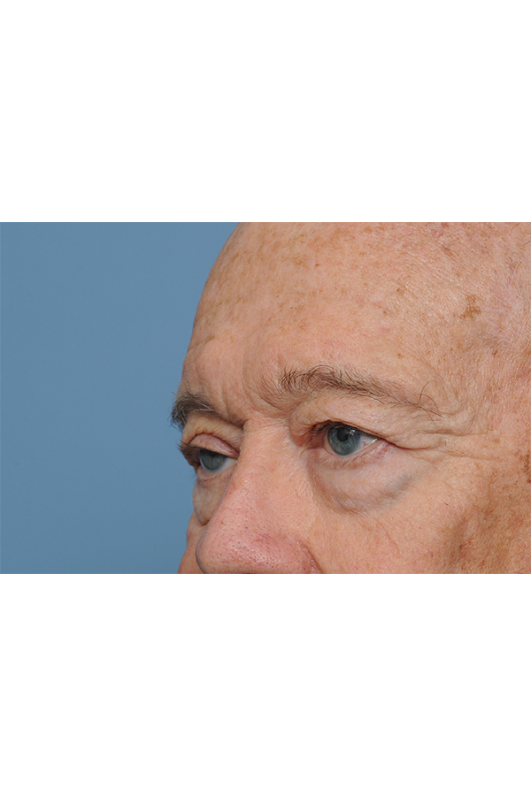 Eyelid Lift Before & After Gallery - Patient 8376646 - Image 7