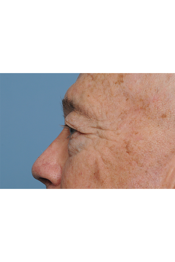 Eyelid Lift Before & After Gallery - Patient 8376646 - Image 5