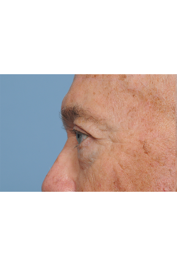 Eyelid Lift Before & After Gallery - Patient 8376646 - Image 6