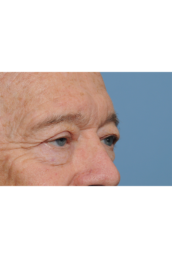 Eyelid Lift Before & After Gallery - Patient 8376646 - Image 11