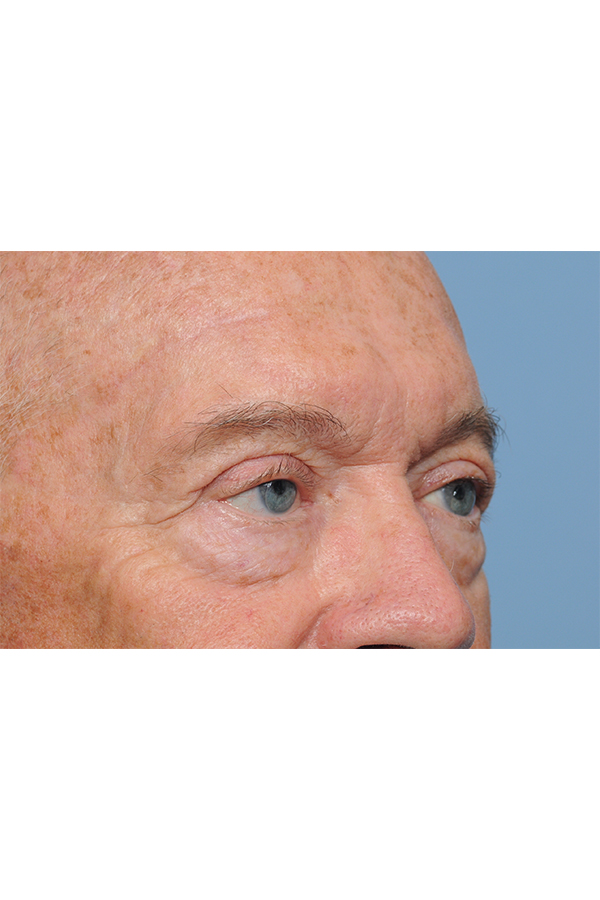 Eyelid Lift Before & After Gallery - Patient 8376646 - Image 12