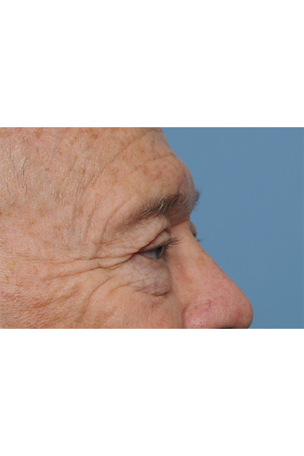 Eyelid Lift Before & After Gallery - Patient 8376646 - Image 9