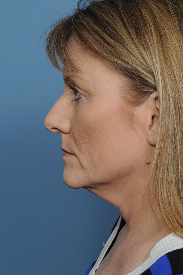 Rhinoplasty Before & After Gallery - Patient 8376738 - Image 1