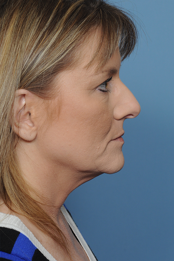 Rhinoplasty Before & After Gallery - Patient 8376738 - Image 7