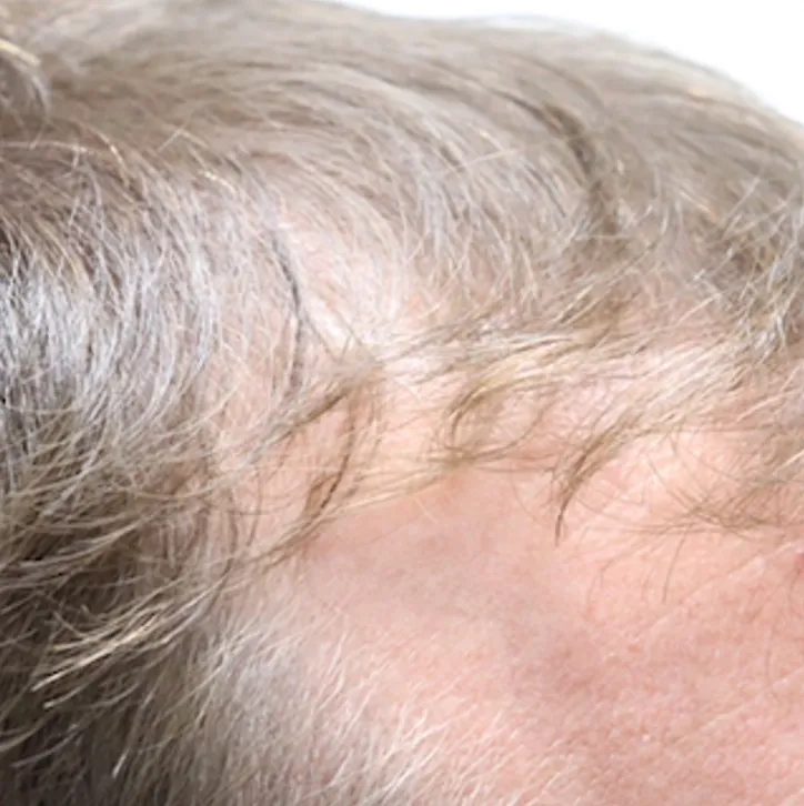 Before and after Hair Restoration with Exosomes in Austin