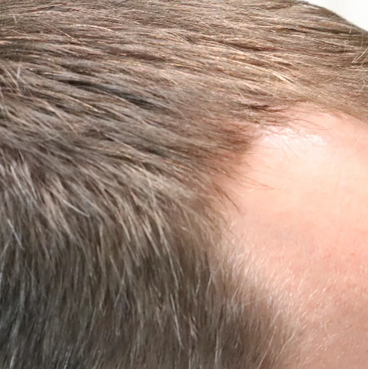 Before and after Hair Restoration with Exosomes in Austin