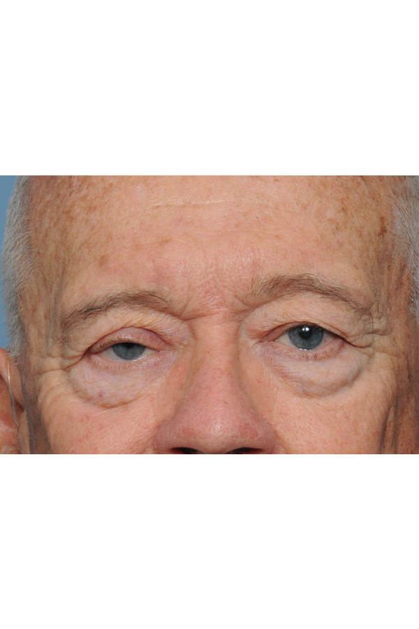 Eyelid Lift Before & After Gallery - Patient 8376646 - Image 3