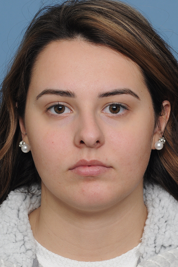 Rhinoplasty Before & After Gallery - Patient 8376727 - Image 3