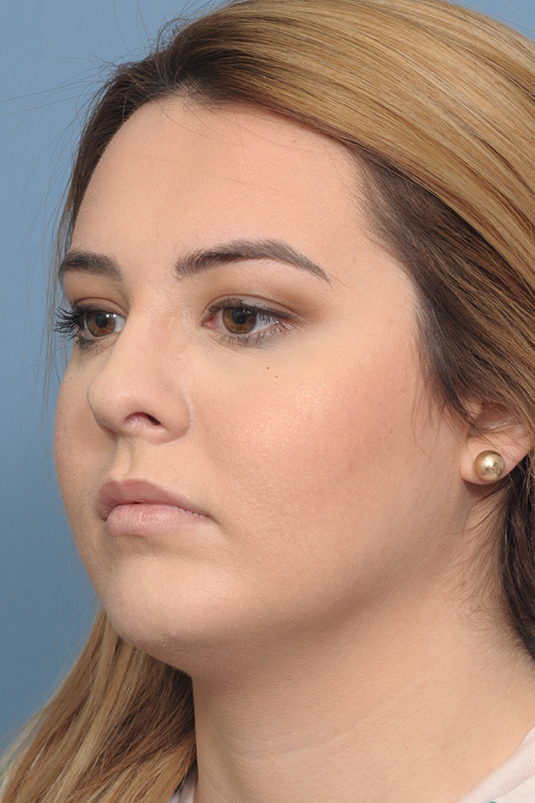 Rhinoplasty Before & After Gallery - Patient 8376727 - Image 6