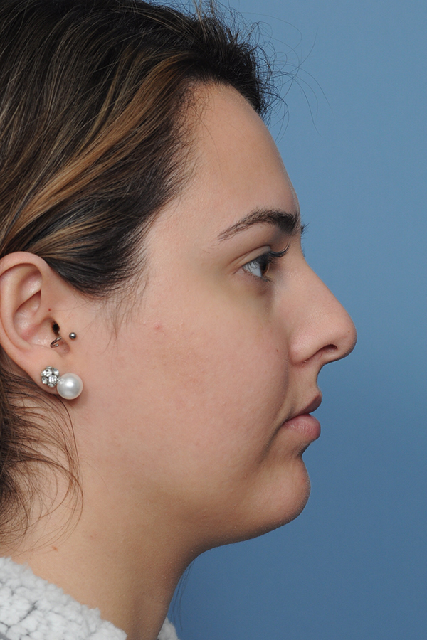 Rhinoplasty Before & After Gallery - Patient 8376727 - Image 9