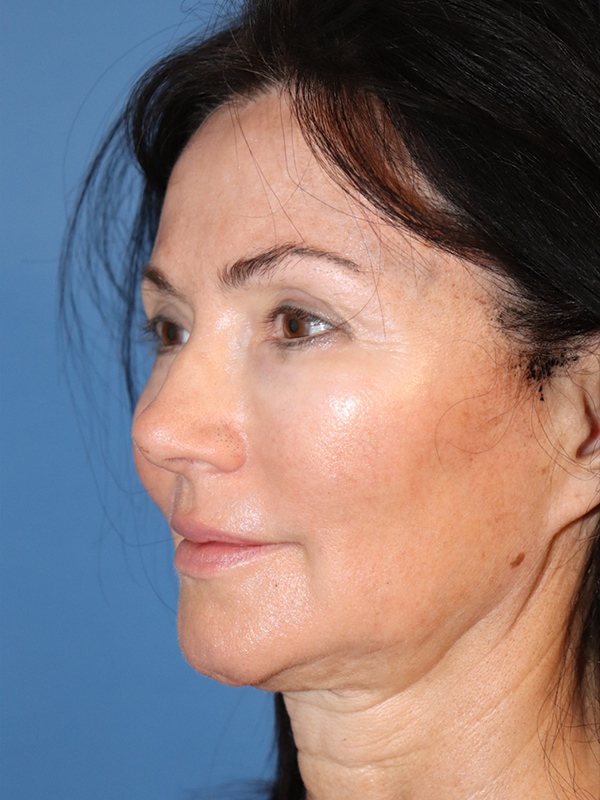 Jawline & Neck Filler Before & After Gallery - Patient 144976896 - Image 1