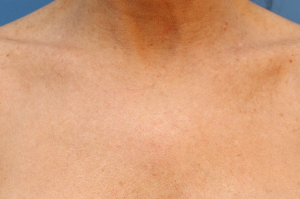 Microneedling Before & After Gallery - Patient 77040321 - Image 5