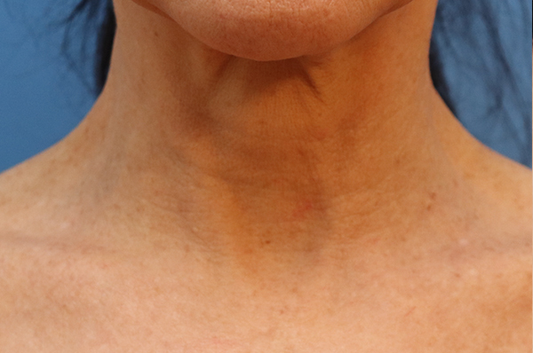 Microneedling Before & After Gallery - Patient 77040321 - Image 3