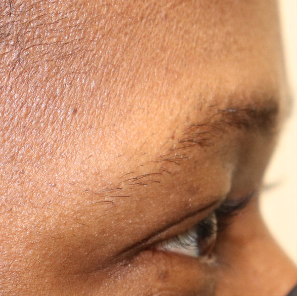 Hair Restoration with Exosomes Before & After Gallery - Patient 32769538 - Image 3