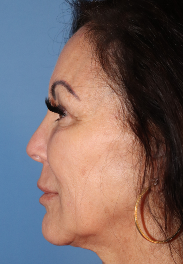 Microneedling Before & After Gallery - Patient 77039598 - Image 5