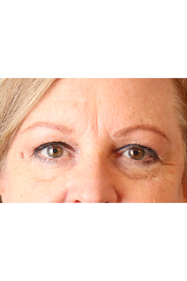 Eyelid Lift Before & After Gallery - Patient 29785295 - Image 3