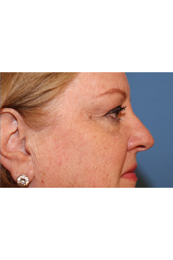 Eyelid Lift Before & After Gallery - Patient 29785295 - Image 7