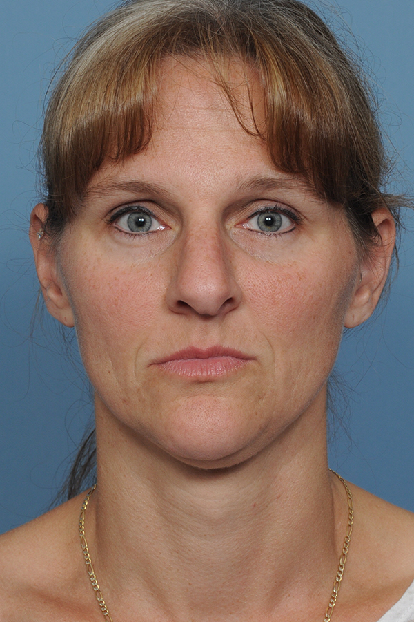 Rhinoplasty Before & After Gallery - Patient 8562223 - Image 3