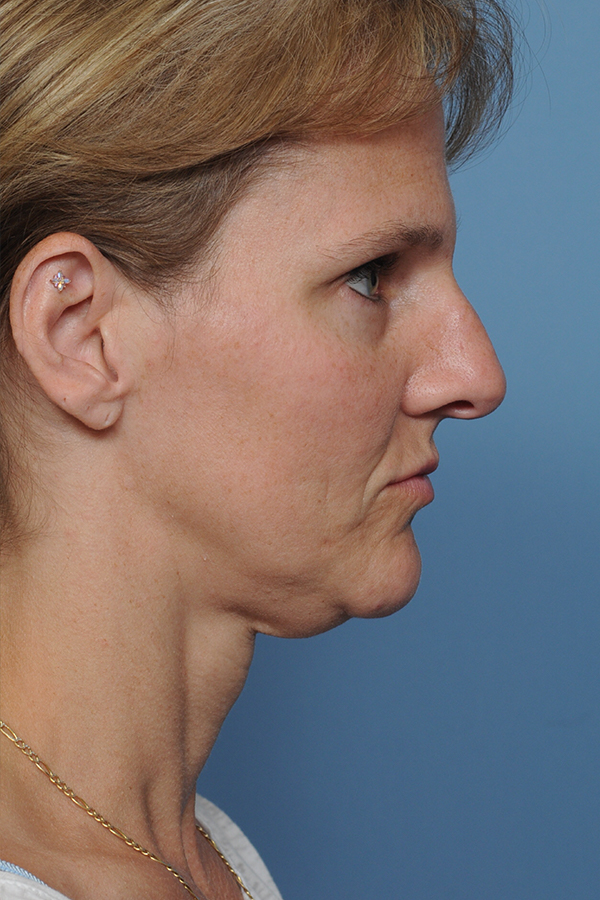 Rhinoplasty Before & After Gallery - Patient 8562223 - Image 5