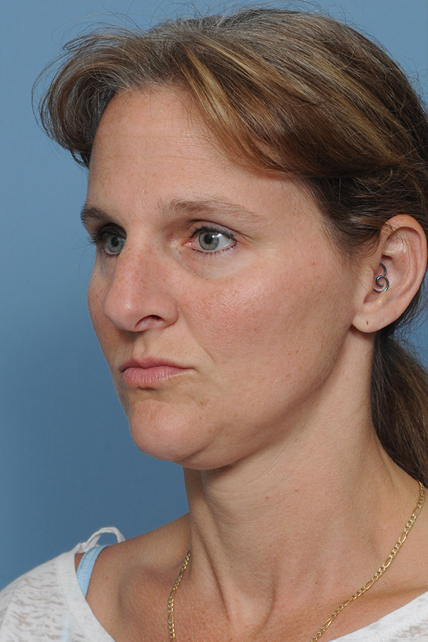 Rhinoplasty Before & After Gallery - Patient 8562223 - Image 9