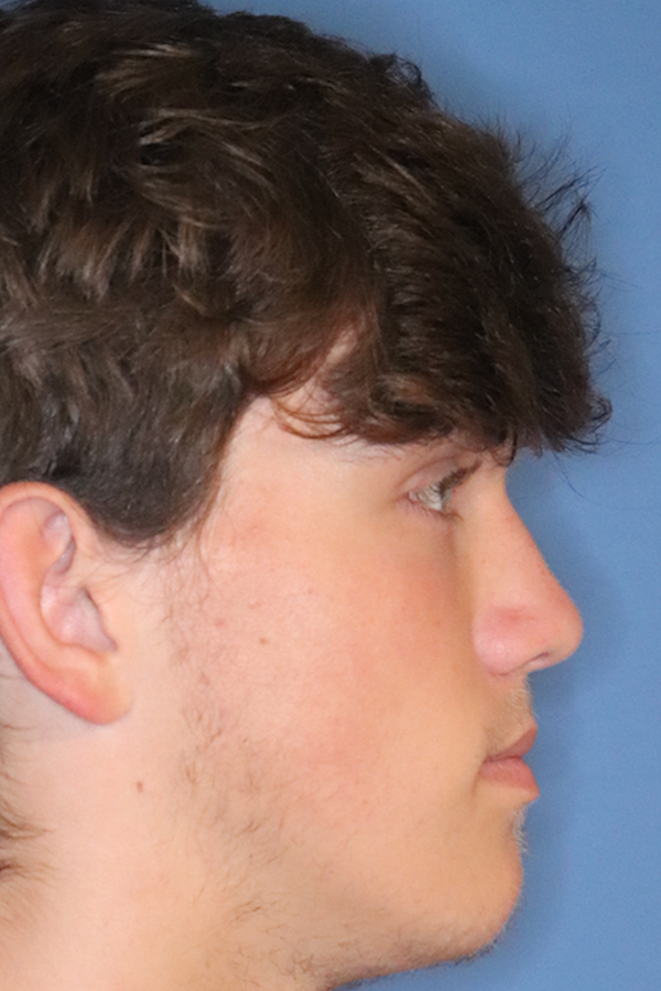 Rhinoplasty Before & After Gallery - Patient 49261259 - Image 4