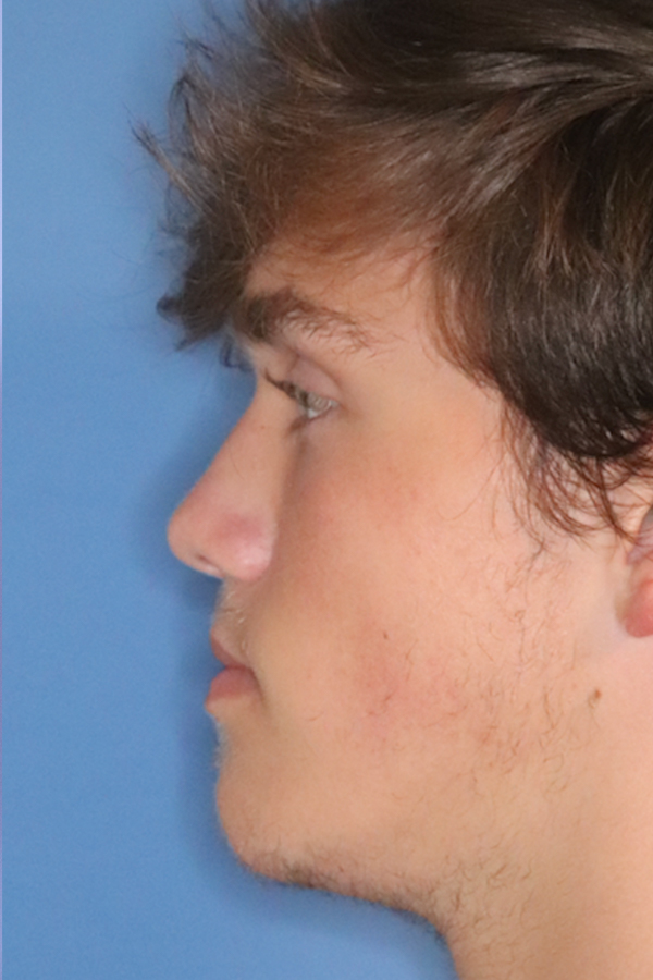 Rhinoplasty Before & After Gallery - Patient 49261259 - Image 2