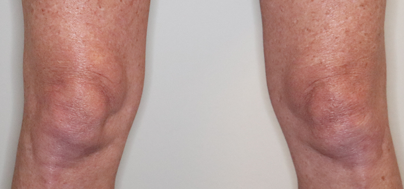 Microneedling Before & After Gallery - Patient 77040323 - Image 6