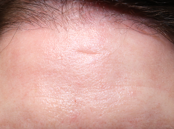 Microneedling Before & After Gallery - Patient 77040367 - Image 1