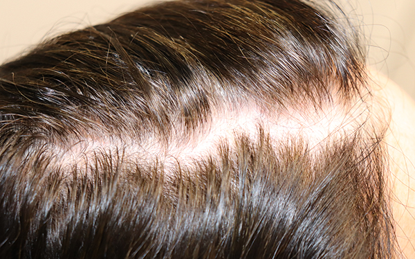 Hair Restoration with Exosomes Before & After Gallery - Patient 39167685 - Image 3