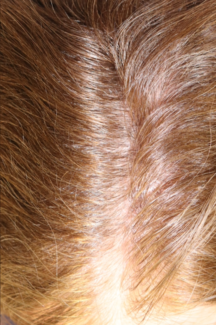 Hair Restoration with Exosomes Before & After Gallery - Patient 32769537 - Image 6