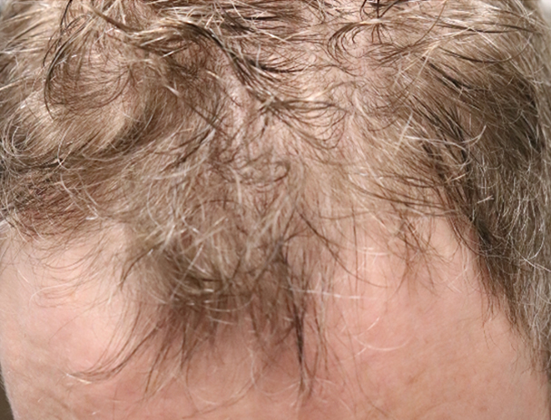 Hair Restoration with Exosomes Before & After Gallery - Patient 49275868 - Image 3