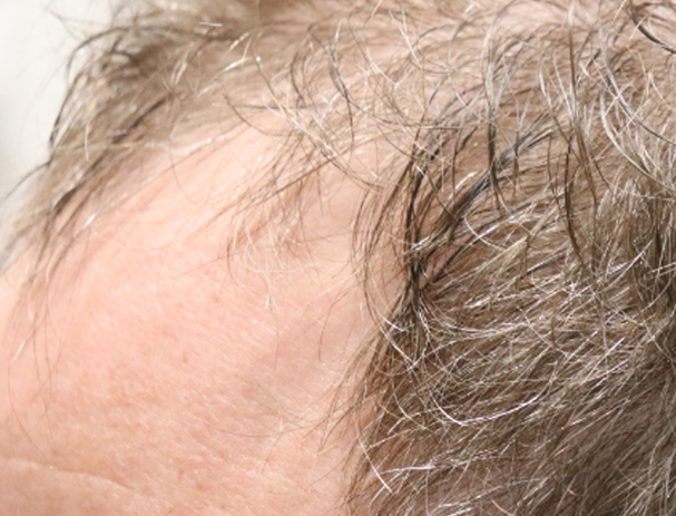 Hair Restoration with Exosomes Before & After Gallery - Patient 49275868 - Image 5