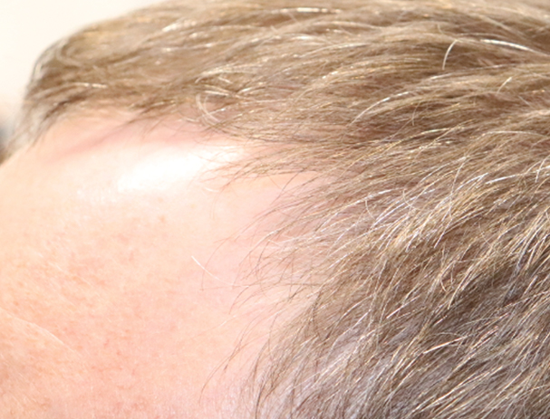 Hair Restoration with Exosomes Before & After Gallery - Patient 49275868 - Image 6