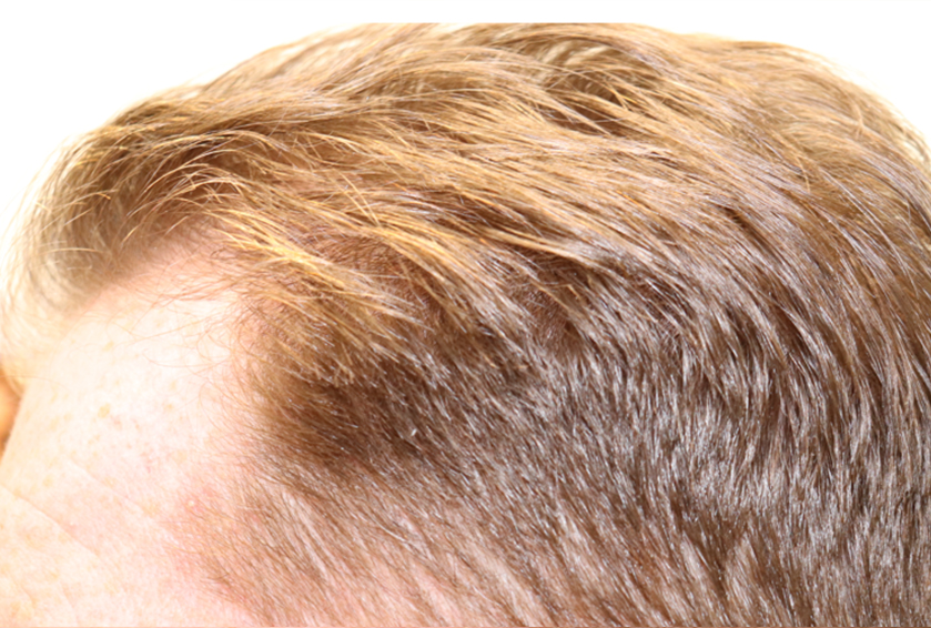 Hair Restoration PRP Before & After Gallery - Patient 77037308 - Image 5