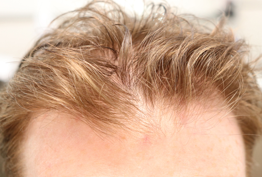 Hair Restoration PRP Before & After Gallery - Patient 77037308 - Image 1