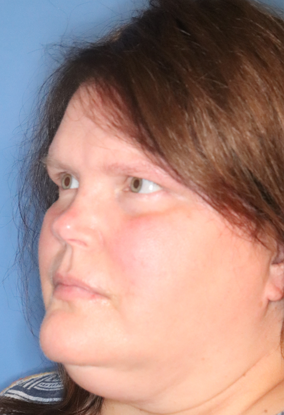 Exosome Facial Before & After Gallery - Patient 77037631 - Image 4