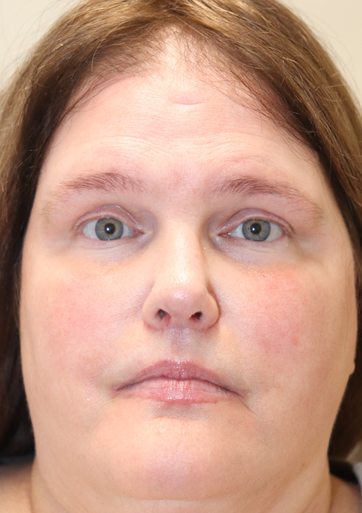 Cheek & Under Eye Filler Before & After Gallery - Patient 145843859 - Image 2