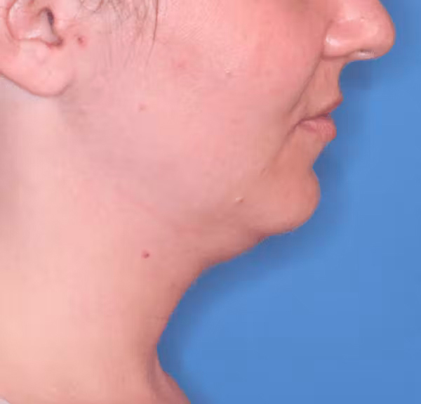 Facial Liposuction Before & After Gallery - Patient 102425576 - Image 1