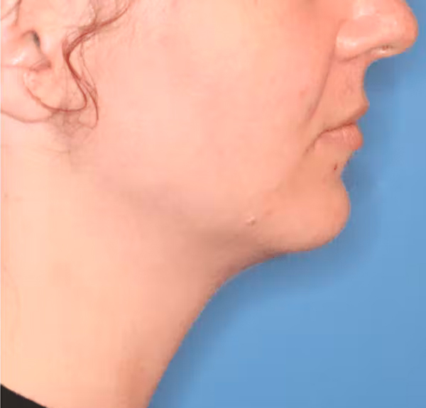 Facial Liposuction Before & After Gallery - Patient 102425576 - Image 2