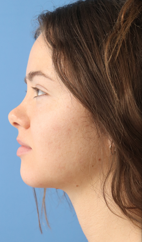 Jawline & Neck Filler Before & After Gallery - Patient 144976912 - Image 3