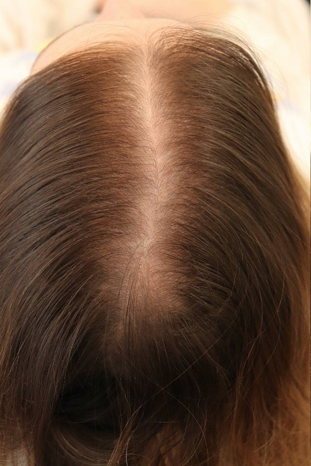 Hair Restoration with Exosomes Before & After Gallery - Patient 77037162 - Image 4