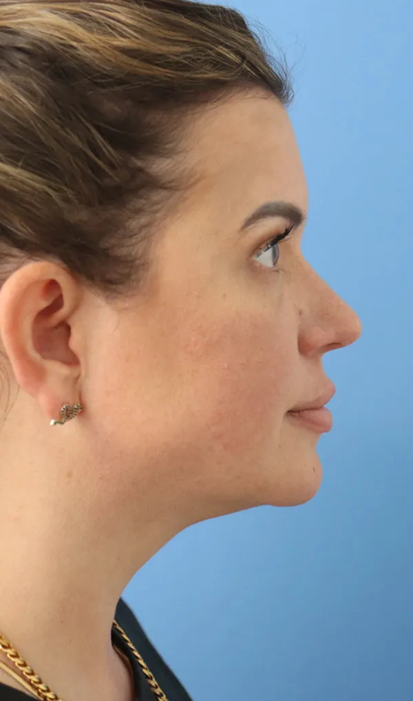 jawline filler before & after