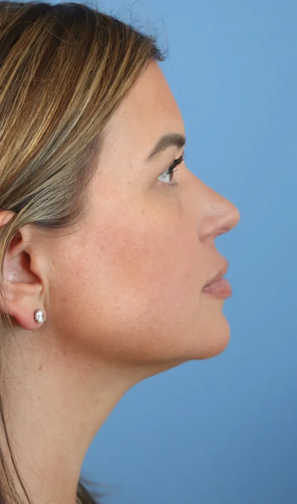 jawline filler before & after