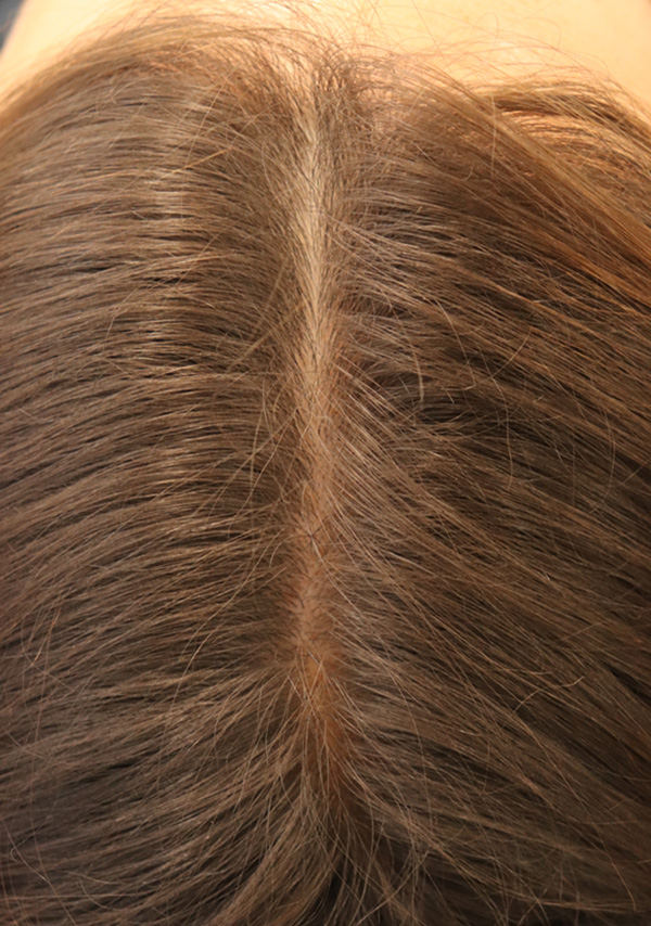 Hair Restoration with Exosomes Before & After Gallery - Patient 122660441 - Image 4