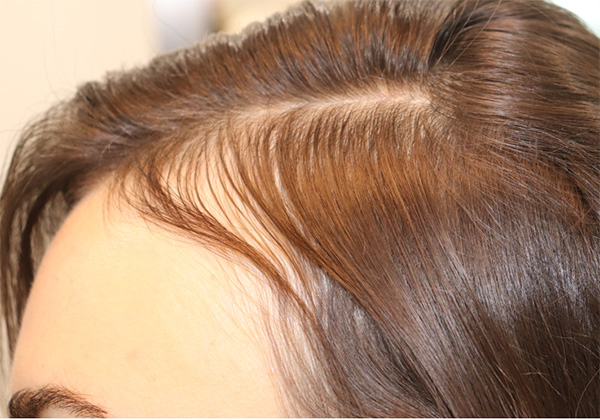 Hair Restoration with Exosomes Before & After Gallery - Patient 122660441 - Image 5