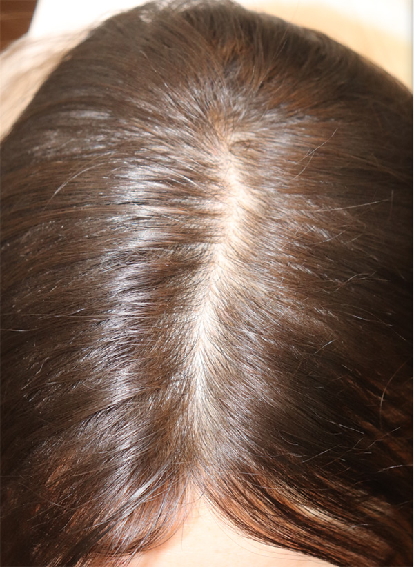 Hair Restoration with Exosomes Before & After Gallery - Patient 122660441 - Image 9