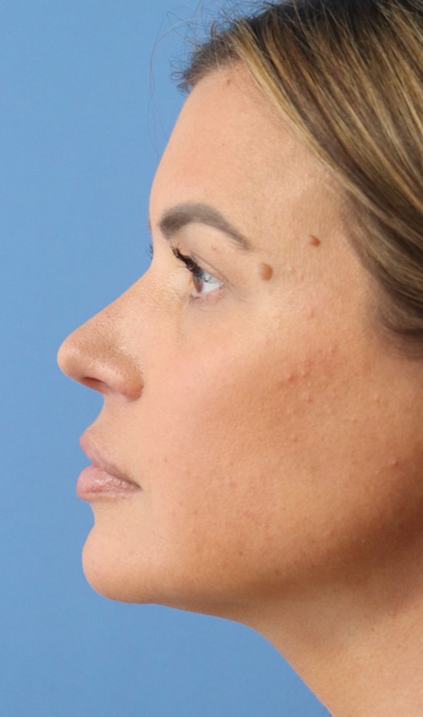 Jawline & Neck Filler Before & After Gallery - Patient 144976915 - Image 4