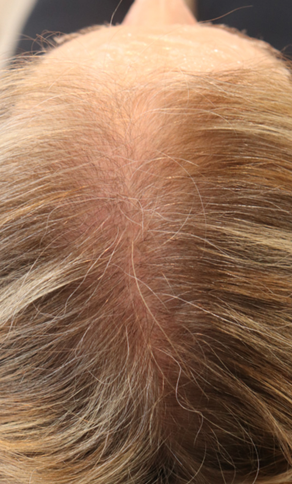 Hair Restoration with Exosomes Before & After Gallery - Patient 122660439 - Image 2